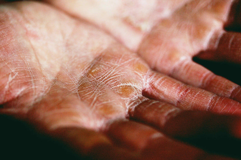 Close-up of a dry, cracked palm with scaling and irritation, typical of hand eczema and dermatitis